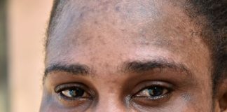 “Produtos cosméticos que clareiam a pele colocam em risco a saúde”