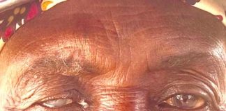 Dos 120 previstos : HCN conseguiu submeter a cirurgias de catarata apenas 113 idosos