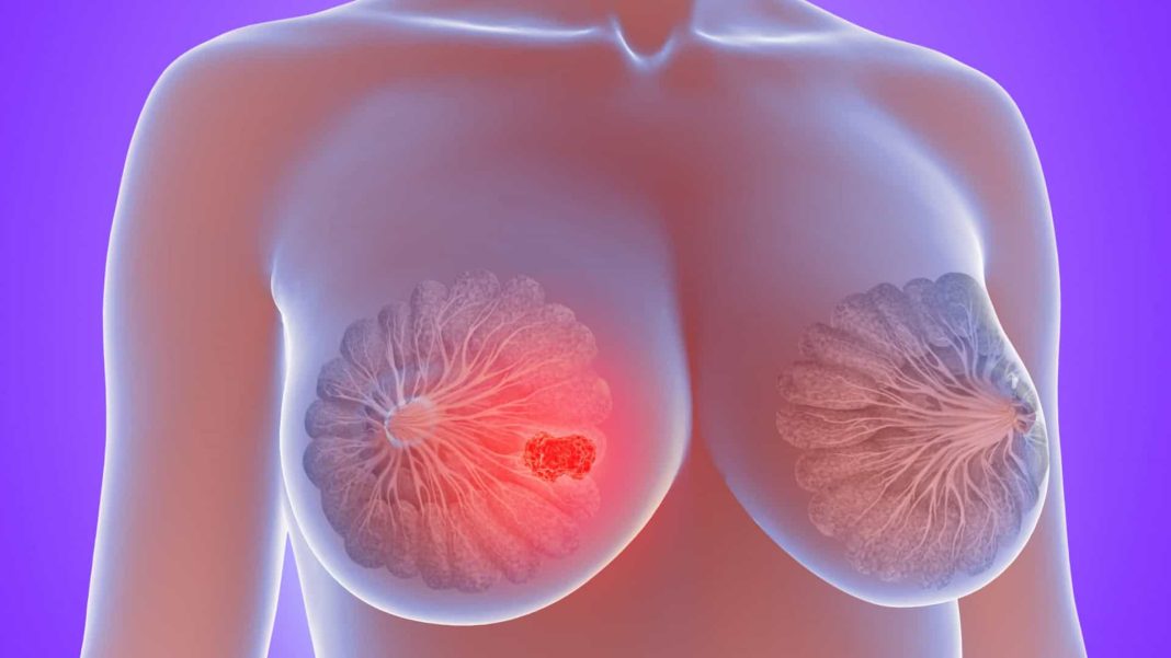 Nampula registou mais de meia centena de casos de cancro da mama em 6 meses